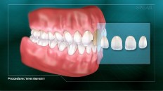 set of teeth with veneers diagram