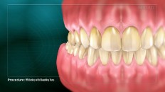 front view of a set of teeth