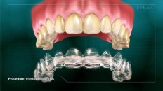 a clear tray under the teeth mold