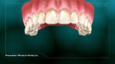 the upper row of teeth
