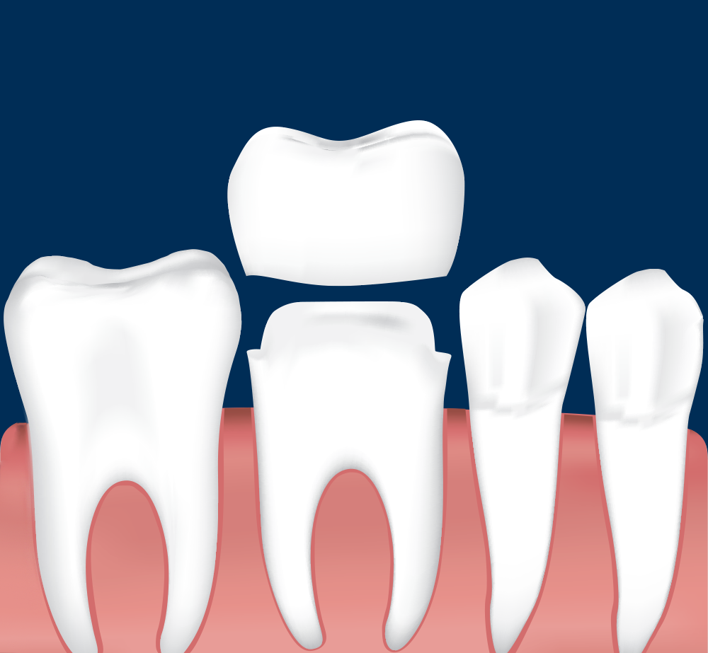 Digital illustration of a dental crown being placed on a tooth that is prepared for crowns with a dark blue background