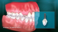 single implant thumbnail