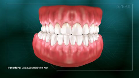 occlusal appliance for tooth wear thumbnail