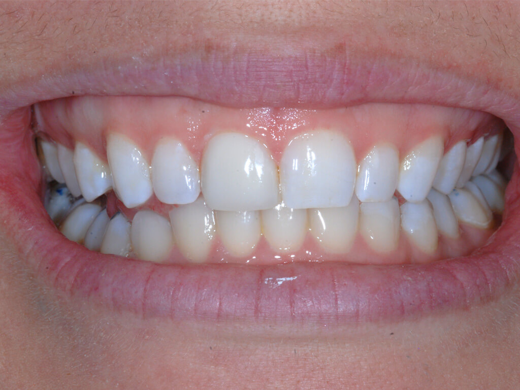 A person smiling with their discolored tooth repair