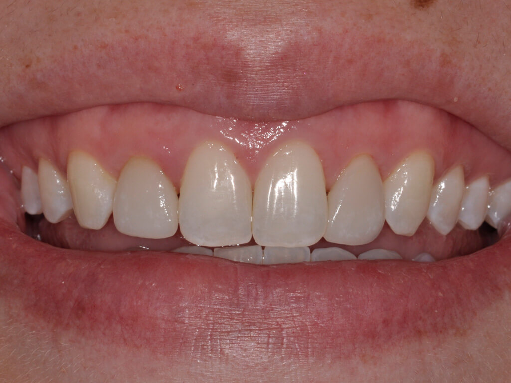 A patient with their new Hollywood smile