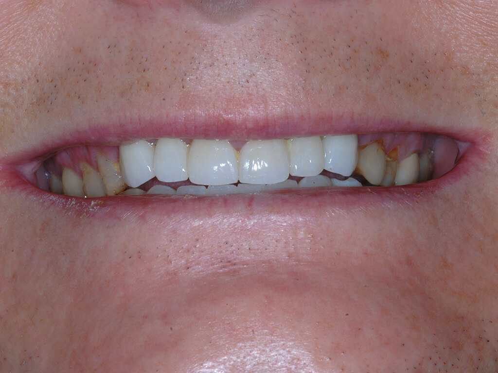 A patient smiling with fully restored teeth