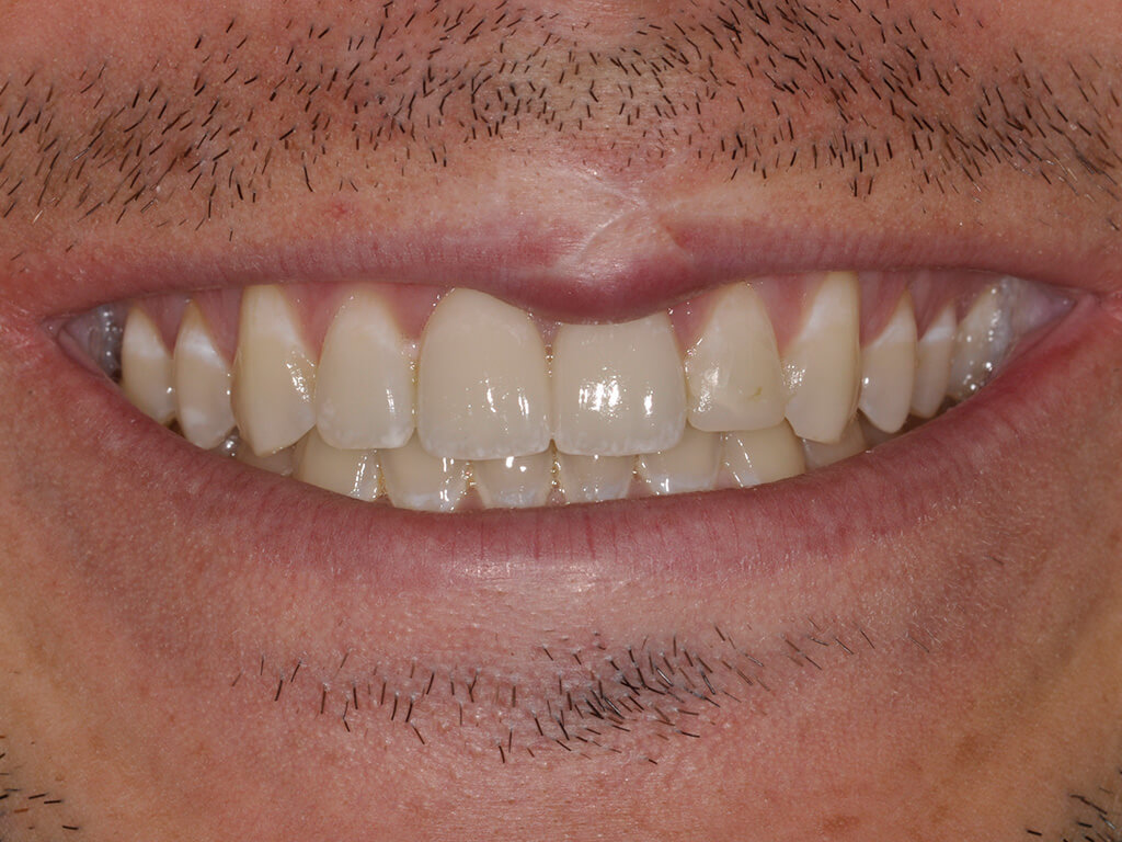 A person smiling after having a chipped tooth repaired