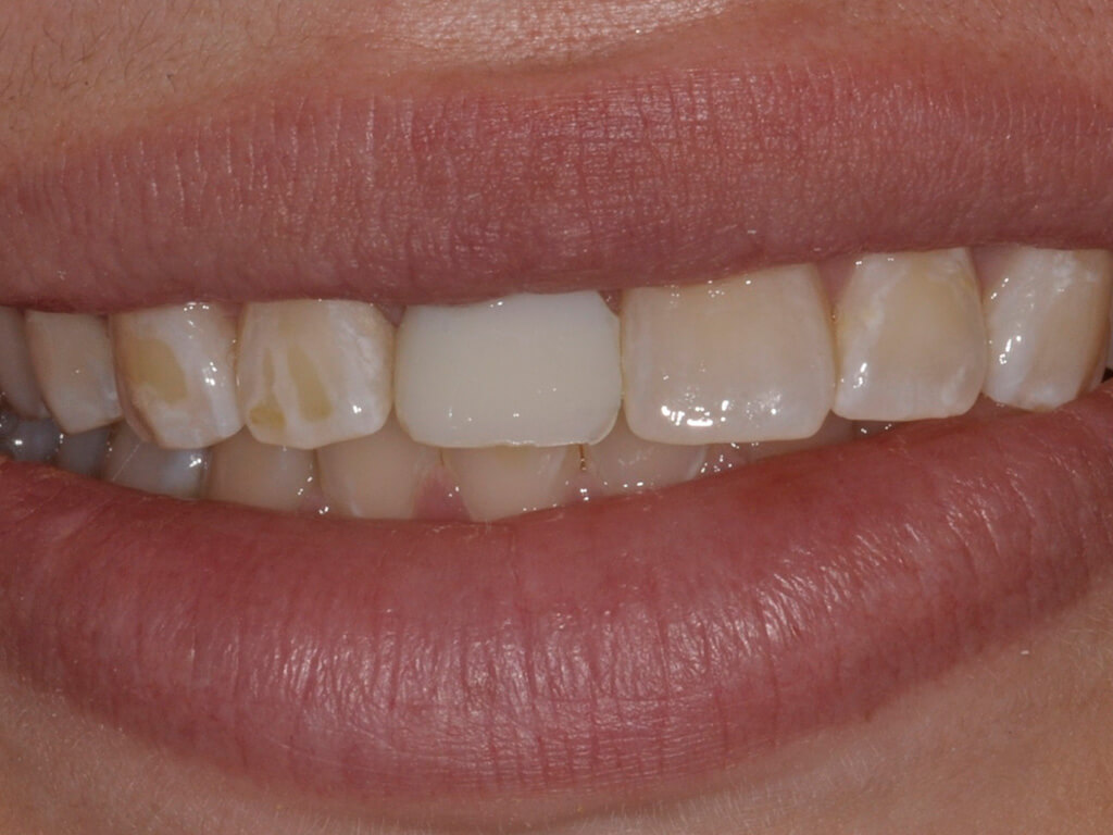 A person smiling before having an e. max crown cemented