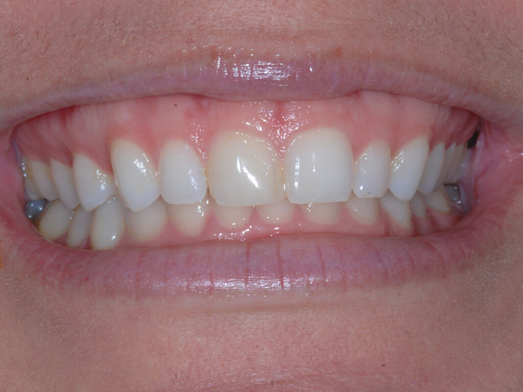 A person smiling before having their teeth clean