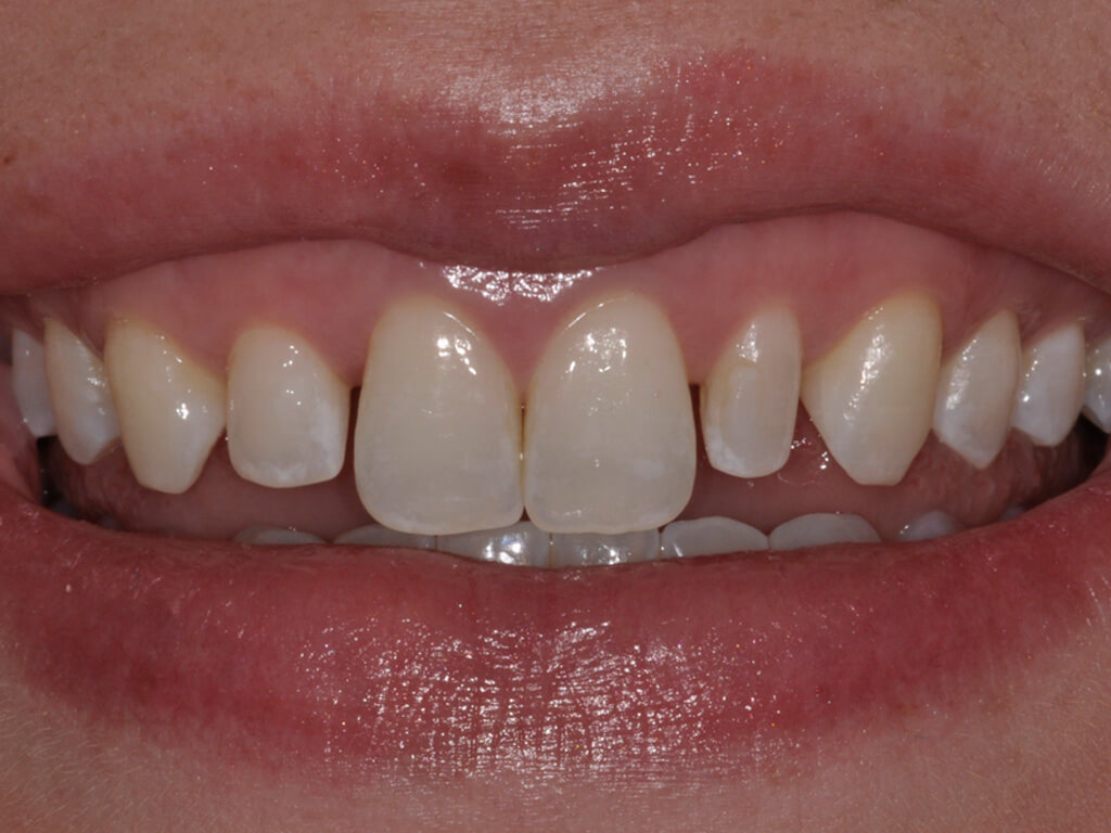 A woman smiling before her new veneers