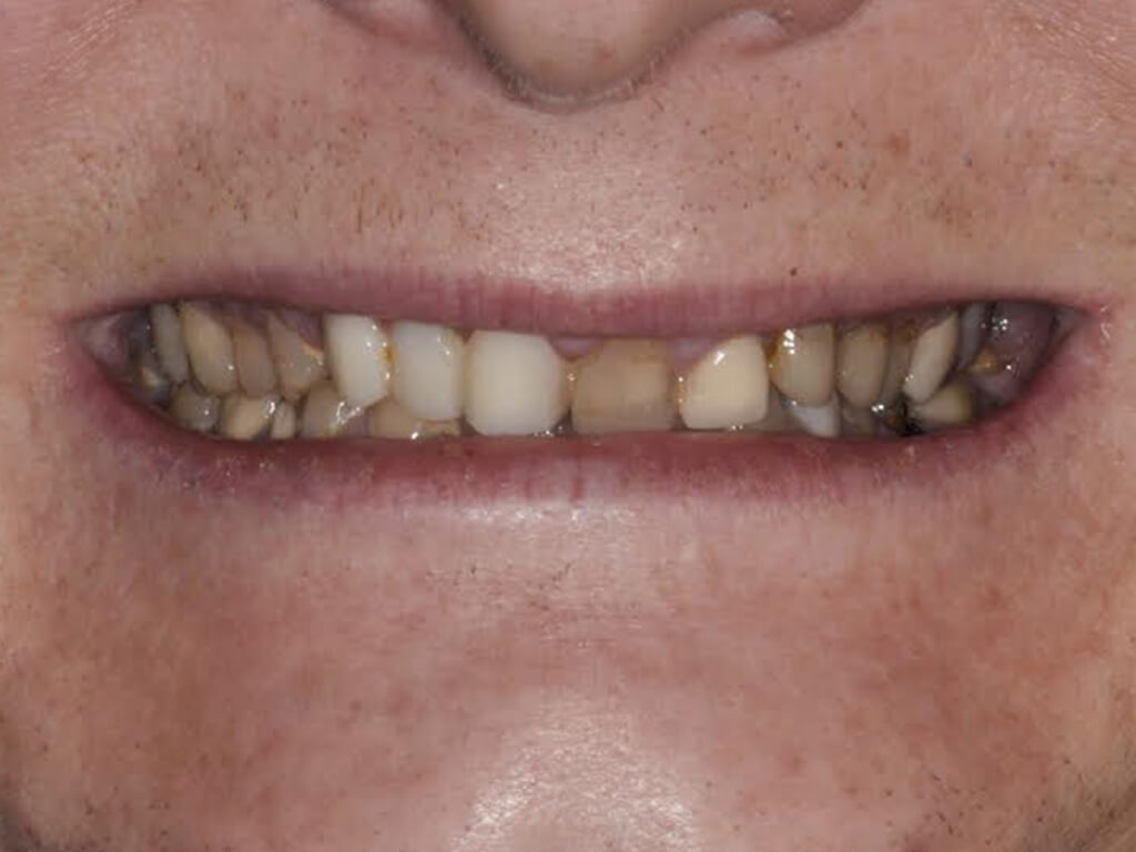 A patient smiling with discolored teeth