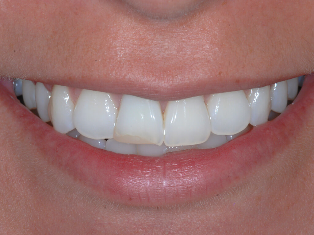 A before photo of uneven teeth