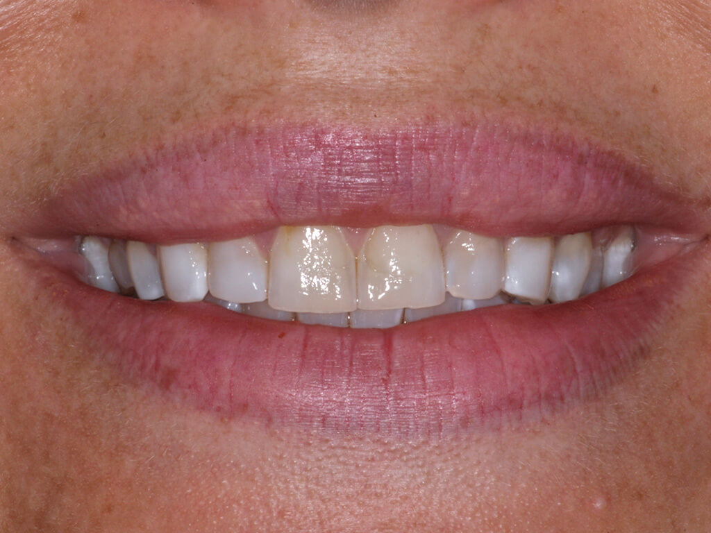 A person smiling showing their teeth before a procedure