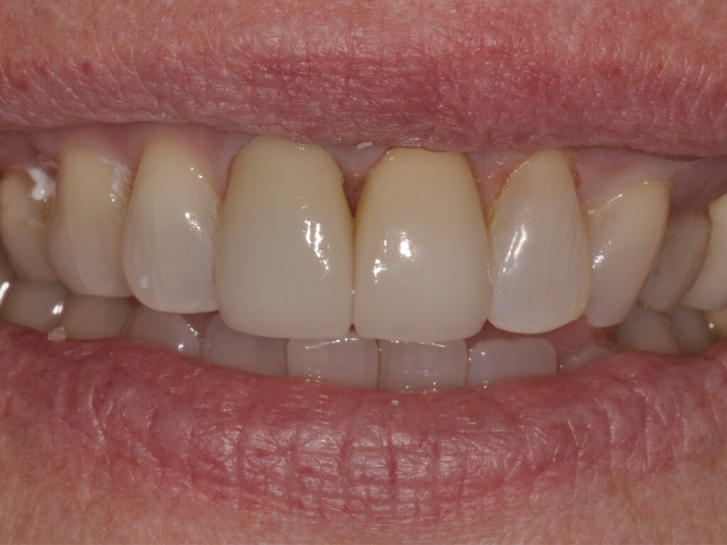 A closeup of a set of clean teeth
