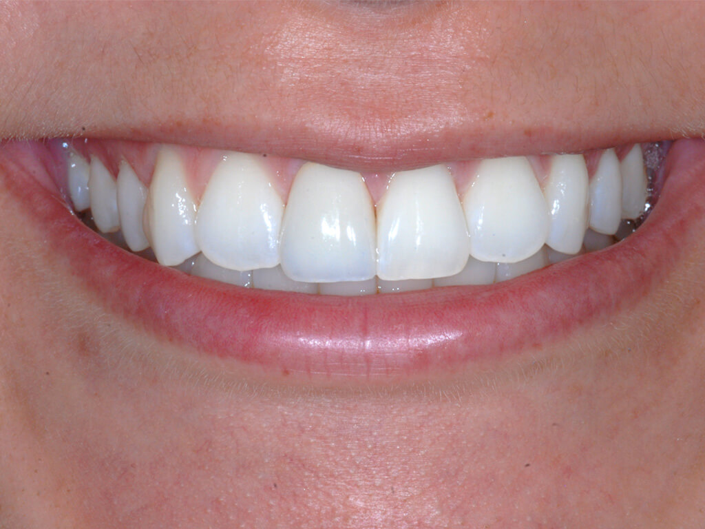 A closeup of a patients renewed smile
