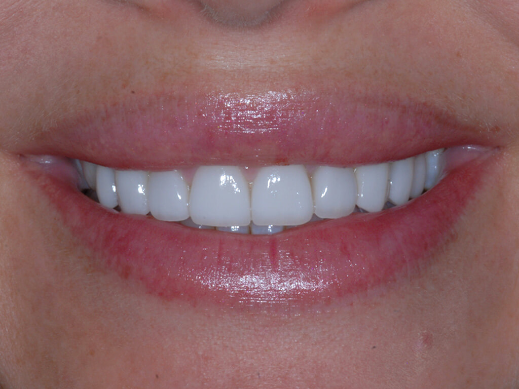 A person smiling showing off the procedure they had done