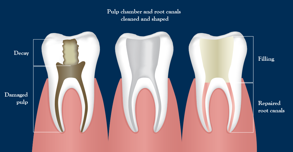 A diagram of a root canal from damaged tooth to filling with repairs