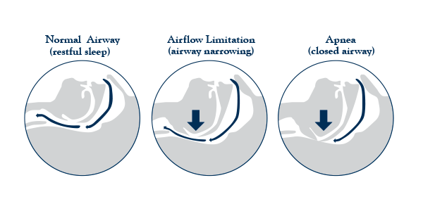A diagram of three people breathing showing various levels of airflow limitation