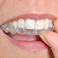 A person inserting Invisalign to their upper row of teeth