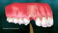 Bone Graft With Immediate Implant Placement thumbnail