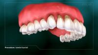 Connective Tissue Graft thumbnail