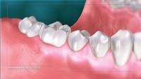 Gingival Probing And Pocket Depth thumbnail