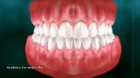 Understanding tooth wear thumbnail