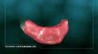 Locator Retained Overdenture thumbnail