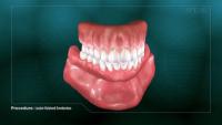 locator retained overdenture thumbnail