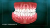 occlusal appliance for tooth wear thumbnail