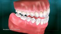 removable complete dentures thumbnail