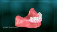 Removable Partial Dentures thumbnail