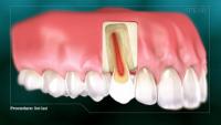 root canal no file thumbnail