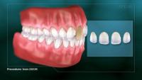 Veneers CAD/CAM thumbnail